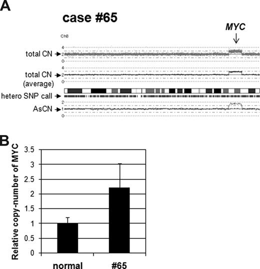 Figure 2. Validation of copy-number change in case no. 65. (A) SNP-chip data of chromosome 8 in case no. 65. Top dots are SNP sites as probes and indicate total copy number (CN). Middle line is an average of the copy number and shows gene dosage. Bars are heterozygous (hetero) SNP calls. Bottom 2 lines show allele-specific copy number (AsCN). (B) Duplication of the MYC gene region in case no. 65. Copy number of the MYC gene in case no. 65 was compared with normal genomic DNA with quantitative genomic real-time PCR. Level of the copy number was determined as a ratio between the MYC gene and the reference genomic region 2p21. Results represent mean of 3 experiments plus or minus SD.