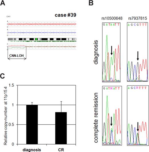 Figure 3. Validation of CNN-LOH in case no. 39. (A) SNP-chip data of chromosome 11 in case no. 39. The samples had CNN-LOH on chromosome 11 (11p-terminal–p14.1, 28.7 Mb). (B) Determination of SNP sequence in 11p CNN-LOH region in case no. 39. 2 SNP sites (rs10500648 and rs7937815) were sequenced. Both SNP sites showed heterozygosity in the complete remission sample, whereas they showed homozygosity in the diagnosis sample. (C) Determination of copy number in the 11p15.4 region. Copy number of 11p15.4 (CNN-LOH region) in case no. 39 at diagnosis was compared with complete remission (CR) sample with quantitative genomic real-time PCR. Levels of the copy number were determined as a ratio between 11p15.4 and the reference genomic DNA, 2p21. Results represent the mean of 3 experiments plus or minus SD.