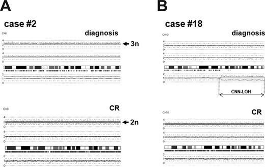 Figure 4. Comparison of chromosomal changes between diagnosis and complete remission samples. (A) Trisomy 8 in case no. 2. Case no. 2 had trisomy 8 at diagnosis, whereas chromosome 8 was 2n at complete remission (CR). (B) CNN-LOH in case no. 18. Case no. 18 had CNN-LOH in chromosome 10 (10q22.2–q-terminal, 58.2 Mb), and the alteration was not present in the matched CR sample.