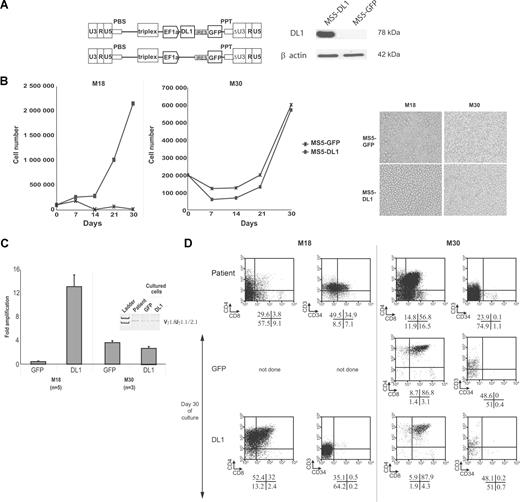 Figure 3. In vitro T-ALL proliferation requires the activation of the NOTCH-signaling pathway. (A) Structure of the bicistronic TRIP-ΔU3-EF1α-IRES-GFP lentiviral vectors encoding or not human DL1 (left panel). Western blot analysis of DL1 expression in MS5 cells transduced with either of the 2 TRIP-ΔU3-EF1α vectors shown in the left panel. (B) Left panels: Representative growth curves observed with M18 and M30 T-ALL samples in coculture with MS5-GFP or MS5-DL1 cells. Right panels: Pictures of the leukemic cell cultures after 16 (M18) and 21 (M30) days of coculture with MS5 cells. Images were obtained using a Nikon Eclipse TE 2000-S (×200; Nikon France SAS, Champigny-Sur-Marne, France) microscope and captured using Eclipse-Net software. Images were processed using Adobe Photoshop software. (C) Amplification rate after 30 days of culture of M18 and M30. Fold amplification is referred to the initial number of plated cells. Shown are mean plus or minus SD of 6 (M18) and 3 (M30) experiments. (Inset) γ-TCR gene rearrangements of M30 at diagnosis and after 30 days of coculture with MS5 cells. (D) Phenotype of T-ALL leukemic cells before and after 30 days of culture with GFP- and DL1-expressing MS5 cells. Percentage of cells is indicated in each quadrant.