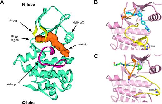 Figure 6. Ribbon representation of ABL1 kinase in complex with tyrosine kinase inhibitors. (A) Ribbon representation of 3-dimensional structure of ABL1 kinase domain (blue) in complex with imatinib (orange). The ATP-binding site in the ABL1 kinase domain is located between the activation loop (A-loop; magenta) and the phosphate-binding loop (P-loop; yellow). The A-loop controls the ABL1 catalytic activity by switching between different states in a phosphorylation-dependent manner. Imatinib inserts its pyridinyl group underneath the helix αC in the NH2-terminal lobe of ABL1 kinase, displacing ATP and trapping the kinase in its inactive conformation. (B,C) The imatinib:ABL1 (blue) and the dasatinib:ABL1 (green) complexes are shown. The A-loop (yellow) adopts diverging positions in the 2 complexes. Conformational changes in the A-loop prevent imatinib binding to the active form of the enzyme. By contrast, dasatinib binds ABL1 in its active conformation and is not involved in critical interactions with most mutated residues involved in imatinib resistance. For instance, the H396 residue is involved in a hydrogen bond that stabilizes the inactive conformation of the A-loop in the imatinib:ABL1 complex (B), whereas no discernible interactions are observed between His396 and ABL1 or dasatinib (C). Thr315 makes a critical hydrogen bond with dasatinib. T315I mutation disrupts this interaction and causes steric clash, impairing the activity of dasatinib, as well as of imatinib and nilotinib, against this mutant.