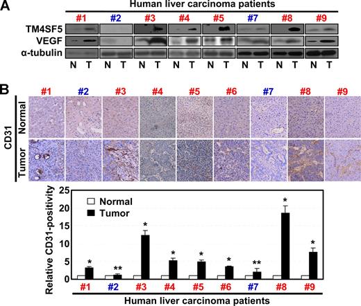 Figure 1. TM4SF5 overexpression correlates with VEGF expression and vessel formation in human hepatocarcinoma. Normal and tumor liver tissues separately obtained from 9 Korean hepatocarcinoma patients were analyzed by standard Western blot for the indicated proteins (A) or by immunohistochemistry for human CD31 at × 100 magnification (B). Western blot for the sixth patient was not shown because the sample was not available for immunoblots. However, a previous report showed that TM4SF5 was overexpressed in tumor tissue of the sixth patient by immunohistochemistry.24 VEGF expression in 7 of 9 cases (cases 1, 3-6, 8, and 9) correlated to TM4SF5 overexpression. Case 2 was negative for TM4SF5, VEGF expression, or vessel formation, and case 7 did not show clear correlations between the parameters. In addition, we could not find any histologic differences in TM4SF5-positive and -negative samples. P values less than .05 were considered significant: *P < .05; **P > .05. Data are representative of 3 independent experiments.