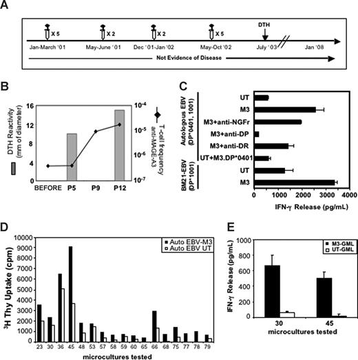 Figure 2. Enumeration and characterization of circulating anti–MAGE-A3 T cells in patient CIP-19 and analysis of anti–MAGE-A3 T cells infiltrating the DTH. (A) Clinical evolution of patient CIP-19 and timing of treatments. (B) Anti–MAGE-A3 T-cell frequency and DTH reactivity after indicated treatments are shown. The frequency of total anti–MAGE-A3 T cells was measured by IFN-γ release assay performed on multiple cultures of PBMCs (105) stimulated and then tested against M3-GMLs and UT-GML. After 12 infusions, we detected a strong increase of circulating anti–MAGE-A3 T cells (1.73 × 10−5). This increase paralleled the development of a strong MAGE-A3–specific DTH reaction. (C) Antigen specificity of a selected CD4+ microculture. Microculture no. 8 was tested against MAGE-A3–transduced (M3) or untransduced (UT) autologous EBV in the presence or in the absence of anti-DR, anti-DP, and anti-NGFr (used as control antibody) mAbs. Anti–MAGE-A3 T cells were also tested against autologous EBV pulsed with the M3.DP*0401 peptide26 and against allogeneic MAGE-A3–transduced or untransduced EBV (BM21-EBV) sharing the HLA-DP*1001 allele. Microculture no. 8 specifically recognized the allogeneic HLA-DP*1001 EBV expressing MAGE-3 but not the M3.DP*0401 peptide. Error bars represent SD of experimental replicates. (D,E) MAGE-A3–specific long-term T-cell memory. (D) CD3+CD4+ T-cell clones from a punch biopsy of an anti–MAGE-A3 DTH performed 9 months after the 14th infusion, proliferated in the presence of MAGE-A3–transduced autologous EBV cells. (E) Upon in vitro expansion, clones no. 30 and no. 45 specifically released IFN-γ in response to MAGE-A3–expressing target cells.