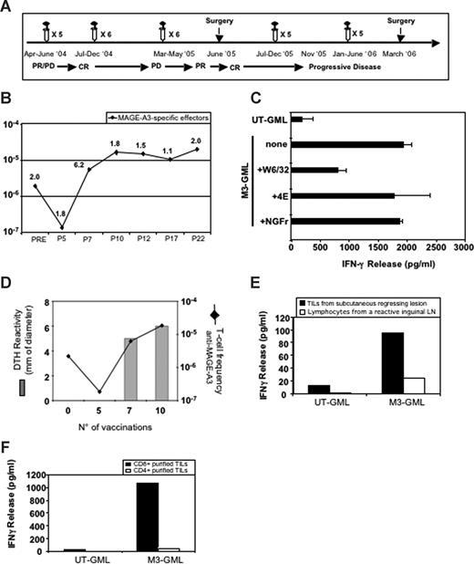 Figure 3. Enumeration and characterization of circulating anti–MAGE-A3 T cells in patient CIP-26 and analysis of anti–MAGE-A3 T cells infiltrating tumor lesions. (A) Clinical evolution of patient CIP-26 and timing of treatments. PD indicates progressive disease; CR, complete response; and PR, partial response. (B) Frequency of circulating anti–MAGE-A3 T cells estimated before, during, and after treatment. The frequency of total anti–MAGE-A3 T cells was measured as described in Figure 2. P indicates after infusion; P30*, this blood sample was withdrawn in 2007, 1 year after the 30th vaccination. (C) HLA restriction of a representative MAGE-A3–specific CD8+ microculture. The microculture released IFN-γ against autologous M3-GMLs preincubated with 4E mAb (recognizing HLA-B and -C alleles) or with anti-NGFr mAb (control mAb). Release of IFN-γ was instead inhibited in the presence of W6/32 mAb (anti–HLA-I mAb). Error bars represent SD of experimental replicates. (D) Relationship between the increase of MAGE-A3–specific effectors and the development of MAGE-A3–specific DTH reaction. (E) Ex vivo IFN-γ release assay performed on anti–MAGE-A3 T cells from a regressing tumor lesion and a regional lymph node collected in 2005. T cells recognized autologous M3-GMLs but not mock-transduced lymphocytes (UT-GMLs). (F) Only CD8+ purified TILs specifically released IFN-γ when challenged with M3-GMLs.