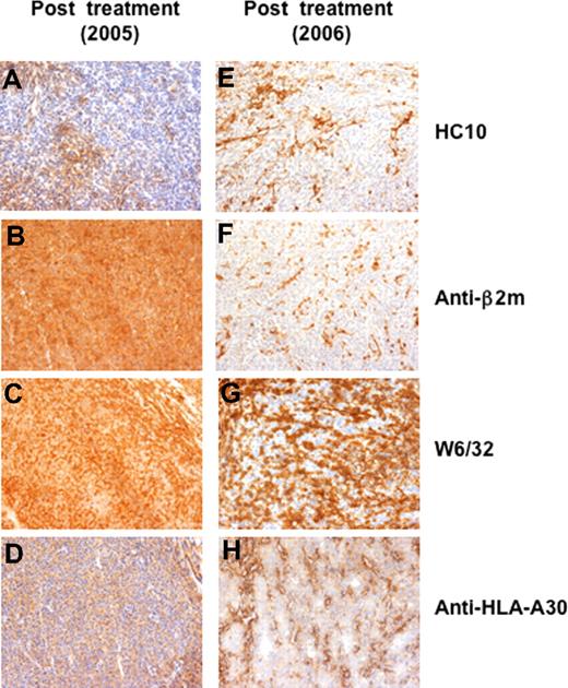 Figure 4. Immunohistochemical analysis of tumor lesions of patient CIP-26 collected during the treatment. (A-G) Melanoma lesions collected during the treatment were stained with HC10 mAb (anti–HLA-B and -C), anti–β2-microglobulin mAb, W6/32 (anti–HLA-I) mAb and anti–HLA-A30 mAb. (A,B) The regressing tumor nodule collected in 2005 after 18 vaccinations, was almost completely negative for HC10 (A), but contained tumor areas stained with anti–β2-microglobulin mAb (B), W6/32 mAb (C) and with an anti–HLA-A30 mAb (D). A progressing tumor lesion collected in 2006, after 22 vaccinations, was not stained by mAb HC10 (E) and by anti–β2-microglobulin mAb (F). Some tumor areas from the progressing lesion were not stained by mAb W6/32 (G) and by an anti–HLA-A30 mAb (H). Objectives, ×200.