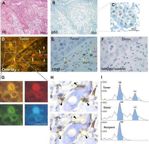 Figure 1. Donor cell origin of an oral squamous cell carcinoma occurring after allogeneic bone marrow transplantation. Tumor of XX genotype occurring in a male patient who received a BM transplant from a female donor. (A) Hematoxylin and eosin staining. Epithelial tumor cells invading the lamina propria of the oral mucosa. (B) Immunostaining with an antibody directed against p53. Nuclei of the basal layers of the squamous cell carcinoma are strongly positive (panel C being higher magnification of the delimited area on panel B). (D-G) Combined immunostainings with FISH methods for X chromosome (green signal) and Y chromosome (red signal). Tumor cells have a XX genotype on overlay D, as shown at higher magnification in panel G, and they are not stained with the Y chromosome–specific probe. Capillary cells (Cap, arrowheads on panels D and E) have a XY genotype on overlay D. Mononuclear CD45+ cells (E) have a XX genotype on overlay D, as shown by green arrows. (H) High magnification of p53-positive tumor cells () before (top picture) and after (bottom picture) laser microdissection. (I) Comparison of the profiles of laser-microdissected tumor cells, inflammatory cells (from the donor), and epidermal cells (from the recipient) from blocks of the same surgical piece. Microsatellite analysis at the D2S138 locus shows that the tumor microdissected cells, because the microdissected inflammatory cells of the donor are heterozygous at this locus (106 and 111 base peaks), whereas the microdissected normal epidermal cells of the recipient is homozygous (106 base peak). Microsatellite analysis of this locus another one (D17S1879, not shown) show the donor origin of the tumor. Images in panels A through C were viewed with an Olympus AX70 microscope (Olympus, Tokyo, Japan) using Olympus UPlan Fl 4×/0.13 NA and 40×/0.17 NA objectives, and taken with a ColorView III digital camera using Olympus-SIS Cell F software. Images in panels D through G were viewed with a motorized Z-axis Olympus BX 61 microscope using an Olympus UPlan Fl 100×/1.3 NA objective and taken with a ColorView III digital camera using Olympus-SIS Cell F software. Image in panel H was viewed with a PALM laser catapulted microdissector system (PALM, Bernried, Germany) on an Olympus IX81 microscope using an Olympus LUCPlanFl 40×/0.6 NA objective and taken with a digital camera using PALM Robo software version 3.