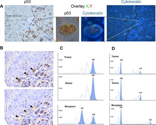 Figure 2. Donor cell origin of an oral squamous cell carcinoma occurring after bone marrow transplantation. Tumor of XY genotype occurring in a female patient who received a BM transplant from a male donor (no previous male pregnancy). (A) Combined FISH XY and immunostainings on the same tissue section with antibodies directed against p53 (brown) and cytokeratin (AE1/AE3; blue), showing strong stainings of the tumor cells. Tumor indicates tumor area, delimited through a large broken line; Ca, capillary lumen in the dermis; inflammatory cells, surrounded by short broken lines, in the dermis. The p53/cytokeratin-positive tumor cells are of XY genotype, as shown with green and red arrows on the enlarged overlaid area. (B) High magnification of p53-positive tumor cells (), surrounded by a yellow line before microdissection in the top picture. The holes left after single cell laser microdissection of the same tumor cells are surrounded by the same yellow line and shown by arrowheads in the lower picture. (C,D) Comparison of the profiles of laser-microdissected tumor cells, inflammatory cells (from the donor), and normal epidermal cells (from the recipient) from blocks of the same surgical pieces shows the profile of tumor cells of donor origin with the use of D17S1879 (C) and D1S2892 (D) STR sequences. For the D17S1879 locus (C), the microdissected tumor cells are homozygous, because of the inflammatory cells of donor origin (158 base peak), whereas the microdissected epidermal cells of recipient origin are heterozygous (154 and 158 base peaks). For the D1S2892 locus (D), the microdissected tumor cells and inflammatory cells of donor origin are similarly heterozygous (102 and 117 base peaks), whereas microdissected normal epidermal cells of recipient origin are differently heterozygous (102 and 125 base peaks). Image in panel A was viewed with an Olympus AX70 microscope using Olympus UPLan Fl 4×/0.13 NA and 40×/0.17 NA objectives, and taken with a ColorView III digital camera using Olympus-SIS Cell F software. Image in panel B was viewed with a PALM laser catapulted microdissector system (PALM, Bernried, Germany) on an Olympus IX81 microscope using an Olympus LUCPlanFl 40×/0.6 NA objective and taken with a digital camera using PALM Robo software version 3.