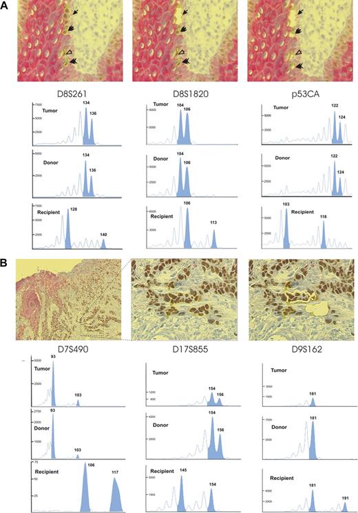Figure 3. Donor cell origin of an oral squamous cell carcinoma occurring after bone marrow transplantation shown by STR-PCR of laser-microdissected cells in 2 sex-matched transplant recipients. (A top) Case III microscopic pictures of sequential cell-by-cell laser-microdissection of p53-positive tumor cells (↙). p53-positive tumor cells are surrounded by a yellow line before laser microdissection (left); the laser microdissection has been performed for the 2 upper tumor cells (middle); the laser microdissection has been performed for all surrounded p53-positive tumor cells (right). Following are microsatellite analyses that used D8S261, D8S1820, and p53CA STR sequences. For the locus D8S261, the microdissected tumor cells and inflammatory cells of donor origin were similarly heterozygous (134 and 136 base peaks), whereas microdissected epidermal cells of recipient origin were differently heterozygous (128 and 140 base peaks). For the locus D8S1820, the microdissected tumor cells and inflammatory cells of donor origin were similarly heterozygous (104 and 106 base peaks), whereas microdissected epidermal cells of recipient origin were differently heterozygous (106 and 113 base peaks). For the locus p53CA, the microdissected tumor cells and inflammatory cells of donor origin were similarly heterozygous (122 and 124 base peaks), whereas microdissected epidermal cells of recipient origin were differently heterozygous (103 and 118 base peaks). (B) Case IV microscopic pictures of p53-positive tumor sheets invading the lamina propria (left), and at high magnification with successive steps of laser-microdissection (middle and right). Following are microsatellite analyses that used D7S490, D17S855, and D9S162 STR sequences. For the locus D7S490, the microdissected tumor cells and inflammatory cells of donor origin were similarly heterozygous (93 and 103 base peaks), whereas microdissected epidermal cells of recipient origin were differently heterozygous (106 and 117 base peaks). For the locus D17S855, the microdissected tumor cells and inflammatory cells of donor origin were similarly heterozygous (154 and 156 base peaks), whereas microdissected epidermal cells of recipient origin were differently heterozygous (145 and 154 base peaks). For the locus D9S162, the microdissected tumor cells and inflammatory cells of donor origin were similarly homozygous (181 base peak), whereas microdissected epidermal cells of recipient origin were heterozygous (181 and 191 base peaks). Images in panels A and B were viewed with a PALM laser catapulted microdissector system (PALM, Bernried, Germany) on an Olympus IX81 microscope using an Olympus LUCPlanFl 40×/0.6 NA objective and taken with a digital camera using PALM Robo software version 3.