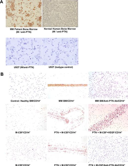 Figure 2. MM tumor cells stimulate tube-like structure formation and Flk-1 staining in freshly obtained CD14+ cells that are blocked by anti-PTN antibodies; PTN and M-CSF induce tube-like structure formation and Flk-1 staining in fresh human monocytes in vitro that is blocked by anti-PTN antibodies. (A) BMMCs from a MM patient containing more than 90% plasma cells and a healthy control subject and U937 cells were stained with either anti-PTN or isotype-matched control antibodies (40×/objective lens, Olympus BX51; Olympus, San Diego, CA). (B top row) CD14+ cells were cocultured with BMMCs from a healthy donor or MM patient containing more than 90% tumor cells with and without anti-PTN antibody using Transwell culture plates for 14 days. Light microscopy of CD14+ cells stained with an anti–Flk-1 antibody is shown. (Middle row) CD14+ cells were exposed to M-CSF alone, PTN and M-CSF together, or the combination of PTN, M-CSF, and VEGF. The cells were stained with anti–Flk-1 antibody using immunohistochemical (IHC). (Bottom row) In a separate experiment, CD14+ cells were exposed to M-CSF alone or the combination of M-CSF and PTN with or without anti-PTN antibody.