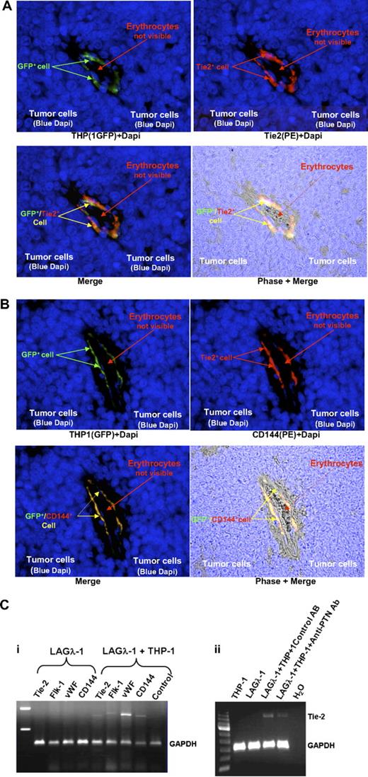 Figure 6. GFP-marked THP-1 cells (THP-1/GFP) coinjected with human LAGλ-1 MM tumor cells into C.B-17 SCID/SCID mice become incorporated into tumor blood vessels and express VEC markers. Human LAGλ-1 MM tumor cells were injected subcutaneously alone or in combination with THP-1/GFP monocytes into mice. Six weeks later, tumors were excised and immediately fixed with formalin. Tumor sections were prepared using standard histologic protocols. (A) Cells expressing GFP were determined using fluorescence and immunofluorescence was determined in sections stained with anti–human Tie-2 and anti-Dapi antibodies. (B) Another tumor blood vessel from a SCID mouse containing LAGλ-1 and THP-1/GFP cells was stained with anti–human CD144 (VE-cadherin) antibodies. Similarly, cells expressing GFP were determined using fluorescence and immunofluorescence was determined in sections stained with anti–human CD144 and anti-Dapi antibodies (100×/oil immersion, Olympus BX51; Olympus). (C) Human LAGλ-1 MM cells coinjected with THP-1 monocytes express VEC genes that are markedly reduced in the presence of anti-PTN antibodies. (i) Human LAGλ-1 MM cells were injected subcutaneously alone or in combination with THP-1 monocytes into mice. Six weeks later, tumors were excised and RNA was extracted. Expression of Tie-2, Flk-1, VWF, CD144, and GAPDH was determined using RT-PCR. (ii) Similarly, human LAGλ-1 MM or THP-1 cells were each injected subcutaneously alone or together into mice also treated twice weekly with intraperitoneal injections of either polyclonal goat anti–human PTN antibodies or control preimmune goat IgG. Six weeks later, tumors were excised and RNA was extracted. Tie-2 and GAPDH expression was determined using RT-PCR.