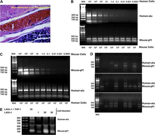 Figure 7. Microdissection of single cells lining blood vessels from LAGλ-1 tumors containing THP-1 cells shows cells with the presence of 3 different types of DNA: only human, both human and mouse, and only murine sequences. (A) Single cells were microdissected from the lining of tumor blood vessels from mice injected with LAGλ-1 and THP-1 cells (100×/objective lens, Olympus BX51; Olympus). (B) To test the sensitivity to detect human DNA with the human-specific alu primers with PCR, we serially diluted human monocytes from 104 to less than a single cell with mouse liver cells. DNA was isolated with salmon sperm DNA protection and separated on 1% agarose gel following 40 cycles of PCR with human alu–specific or mouse pf1–specific primers. The results show that human-specific alu DNA can be detected to a sensitivity of 0.01 human cell equivalents. (C) Similarly, we determined the sensitivity to detect mouse-specific pf1 DNA by serially diluting mouse liver cells in human cells (U266 MM cell line). The results show that mouse-specific pf1 DNA can be detected to a sensitivity of 0.01 mouse cell equivalents. (D) Single cells were microdissected from tumor blood vessels derived from mice coinjected with LAGλ-1 and THP-1 cells, and DNA was isolated with salmon sperm DNA protection and separated on 1% agarose gel following 40 cycles of PCR with human alu–specific or mouse pf1–specific primers. Three different patterns of PCR-amplified products were identified: human DNA alone, mouse DNA alone, and both human and mouse DNA. (E) Single cells were microdissected from the lining of tumor blood vessels from mice injected subcutaneously with LAGλ-1 + THP-1 cells. DNA was isolated with salmon sperm DNA protection and separated on 1% agarose gel following 40 cycles of PCR with human alu–specific or mouse pf1–specific primers. The lanes containing 20 and 30 cells were derived from microdissected single cells that were combined together for PCR analysis. Single cells lining the tumor blood vessels derived from mice injected with human LAGλ-1 cells alone showed the presence of only mouse DNA in tumor blood vessels, whereas mice injected with LAGλ-1 and THP-1 cells together showed the presence of both human and mouse DNA.