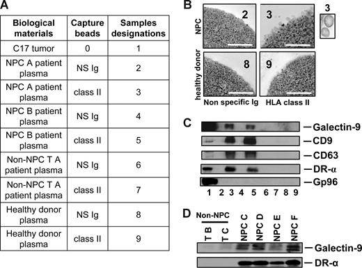 Figure 2. Specific detection of galectin-9–containing exosomes in the plasma of NPC patients. (A) Captures with anti–HLA class II beads were performed on low-density vesicles (110-kg pellets) derived from human plasma samples. Initially, plasmas were collected from 2 NPC patients (NPC A and B; samples 2, 3, 4, and 5), 1 patient with a non-NPC head and neck carcinoma (non-NPC TA; samples 6 and 7), and 1 healthy donor (samples 8 and 9). In each case, beads coated with nonspecific Ig (NS Ig) were used as negative controls. In addition to plasma material, a protein extract from the C17-xenografted tumor was used as a positive control for Western blot detection (no. 1). Clinical and pathologic data on donor patients are provided in Tables S1 and S3. (B) Numerous bilamellar vesicles approximately 70 nm in diameter are visualized by HLA class II capture and electron microscopy when these procedures are applied to plasma vesicles from NPC patients but not control subjects. Scale bar represents 500 nm. In the inset, 2 vesicles at original magnification (× 4). (C) In parallel experiments, Western blot analysis revealed expression of galectin-9, CD9, CD63, and the α chain of the DR molecule in NPC plasma vesicles. In contrast, none of these proteins is detected when the same procedure is applied to control plasmas. Gp96 is only detected in the tumor extract. (D) Galectin-9–carrying exosomes are captured by anti–HLA class II beads from 4 additional samples of NPC plasmas (NPC C, D, E, and F) but not from 2 control subjects with non-NPC tumors (non-NPC TB and TC). Clinical and pathologic data on donor patients are in Tables S1 and S3. Consistent results were obtained for 11 NPC and 5 non-NPC additional plasma samples (see Tables S1, S2, and S4 and Figures S1 and S2).