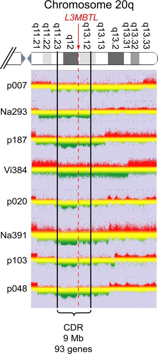 Figure 2. CGH. Granulocyte DNA from patients and a reference DNA were used to perform custom high-density oligonucleotide CGH arrays. The graphs show the log ratios for all probes located on chromosome 20q. Green represents regions deleted in the patient's DNA. The boundaries are marked by a clear drop in the ratio between the patient's DNA and the reference. Patient Vi384 delineates the centromeric and patient Na293 the telomeric border of the CDR, which spans 9 Mb and includes 93 genes.