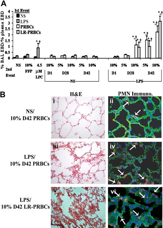 Figure 1. The plasma from stored PRBCs causes lung injury in a 2-event in vivo model of TRALI. (A) Sprague Dawley rats were injected intraperitoneally with 0.9% saline (NS; ■ left or NS middle) or endotoxin (LPS, left, LPS right) 2 hours prior to transfusion (first event) and then infused with NS or 10% FFP (controls), 4.5 μM lysophosphatidylcholines (LPCs, positive control), or the plasma from D1, D28, and D42 PRBCs () or LR-PRBCs () at 5% or 10% of the total blood volume. The percentage of Evans blue dye (EBD) leak from the plasma to the bronchoalveolar lavage (BAL) was measured (% BAL EBD/% plasma EBD, y-axis) and is shown as a function of treatment group (x-axis). No rats treated with NS as the first event demonstrated significant EBD leak (ALI) nor did animals injected with LPS followed by NS, 10% FFP, the plasma (10%) from D1 PRBC or D1 LR-PRBCs, or the plasma (5%) from D28 PRBCs and LR-PRBCs. However in rats treated with LPS and then infused with the plasma from D28 PRBCs (10%) or D28 LR-PRBCs (10%), D42 PRBCs (5%-10%) or D42 LR-PRBCs (5%-10%), or LPCs, the lipids from stored PRBCs, significant EBD leak occurred compared with the controls (*P < .05 from LPS/NS, †P < .05 from LPS/10% FFP, n = 4 for each bar). (B) Rats were pretreated with NS or LPS 2 hours prior to infusion of plasma from D42 PRBCs or D42 LR-PRBCs at 10% of the total blood volume. After 6 hours, the rats were humanely killed, and the lungs were removed, embedded in OCT compound, and snap-frozen. The lungs were sectioned and stained with H&E (left column) or underwent immunohistochemistry to identify rat PMNs (right columns) that used a specific rabbit antirat granulocyte antibody followed by a fluorescently labeled goat antirabbit antibody (red). The sections were visualized at 40×. Rats pretreated with NS and infused with plasma (10% total blood volume) demonstrated normal pulmonary histology (i) with intact endothelium and alveoli with a few scattered PMNs (red) in the vasculature; and the lung parenchyma including the vasculature were stained with WGA (green, membrane stain) and bis-benzamide (blue, nuclear stain) (ii). In rats treated with LPS and then infused with 10% plasma from D42 PRBCs (iii,iv) or D42 LR-PRBCs (v,vi) the histology demonstrates PMN infiltration, pulmonary edema, arcuate inflammation, and hyaline membrane formation. In addition, the PMN infiltration was confirmed by the immunohistochemistry, which demonstrated widespread PMN margination into the lung (red), further demarcated with the white arrows (iv,vi; n = 2).