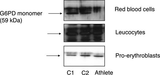 Figure 1. Instability of mutant G6PD. Western blot analysis was performed on red blood cells, leukocytes, and ex vivo–cultured proerythroblasts10 from 2 controls (C1 and C2) and the athlete, using a polyclonal antibody against G6PD (kindly provided by Robin van Bruggen, Sanquin Research, Amsterdam, The Netherlands). In contrast to leukocytes and ex vivo–cultured proerythroblasts, mutant G6PD was not detectable in the athlete's erythrocytes.