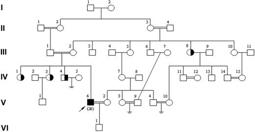 Figure 1. Pedigree of family B with the HJV G99R mutation. The proband (IV-6) is married to his cousin once removed (V-2), who is wild type. Only the proband, his wife, siblings, and aunt (III-8) were available for testing. Arrow indicates proband. Age at diagnosis is shown in parentheses.