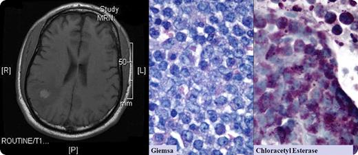 A 56-year-old man had a history of acute promyelocytic leukemia and had been in remission for 2 years. He developed the new onset of seizures. Brain MRI showed 2 well-circumscribed right parietal lobe lesions (one lesion shown above). Spinal fluid cytology was negative for malignant cells. Bone marrow aspiration and biopsy were negative. The neurosurgeon resected these lesions that were within brain tissue and distinct from the meninges. Microscopic review revealed an infiltrate of immature cells, CD10- and CD117-positive, and containing granules that appeared as promyelocytes. / Granulocytic sarcomas are rare collections of acute leukemic cells that can occur in any soft tissue area, including bone, skin, lymph nodes, breast, ovary, meninges, orbit, and optic nerve. In early reports, they were known as chloromas, because of their rich myeloperoxidase content that appeared green. Granulocytic sarcomas appear in individuals who have normal marrows. They usually precede marrow involvement by acute leukemia or chronic myelogenous leukemia by months to years. / After the neurosurgical procedure, the patient received localized CNS radiation. Three months later, a repeat bone marrow aspiration showed near-total replacement with promyelocytes. He was given aggressive chemotherapy followed by consolidation with all-trans retinoic acid and arsenic trioxide. Four months later, there was no evidence of recurrence, either on MRI or in the marrow.