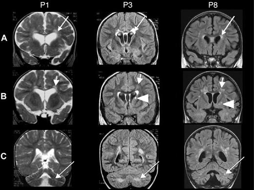 Figure 1. Brain MRIs of patients 1, 3, and 8. Coronal brain MRIs of patients P1 (taken at age 20 months, 11 months after HSCT), P3 (age 6 years, 2 months before HSCT), and P8 (age 3 years, 3 months after HSCT). T2-weighted images are shown for P1, and fluid attenuation inversion recovery (FLAIR) images are shown for P3 and P8. (A) Bilateral, abnormal hyperintensities in the periventricular white matter (arrows) and the anterior part of the corpus callosum. (B) Abnormal hyperintensities in the white matter, the periventricular area but not of the U fibers (arrows), and a unilateral signal abnormality in the basal ganglia (the caudate nucleus in P3 and the putamen in P8; arrowheads). (C) White matter abnormalities in the cerebellum (arrows).