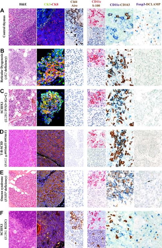 Figure 1. Thymic compartmentalization and maturation of mTECs, DCs, and nTregs is abrogated in patients with severe defects in T-cell development but is preserved in a patient whose genetic defects are largely permissive for T-cell development. Detailed analysis of the thymic biopsy from a representative normal thymus (A) shows defined CMD (hematoxylin and eosin staining) with normal compartmentalization of CK8+CK5− cTECs (CK8, red staining) and CK8−CK5+ mTECs (CK5, green staining). Mature mTECs express Cld4 and Aire (brown staining, top and bottom images, respectively). In contrast, mutations that abrogate T-cell development (reticular dysgenesis, B; γc-null SCIDX1, C; RAG2-null T−B−SCID, D) or that are only partially permissive for T-cell development (Omenn syndrome associated with RMRP mutations, E), are associated with profound atrophy and loss of CMD (hematoxylin and eosin staining), highlighted by the presence of a diffuse epithelial network mostly composed of CK5 and CK8 double-positive immature TECs (yellow staining). No expression of claudin-4 (Cld4) and Aire was detected in these samples. In contrast, as shown in panel F, the biopsy from the patient carrying a hypomorphic R222C mutation in the IL2RG gene, permissive for T-cell development, shows normal thymic architecture with CMD (hematoxylin and eosin staining), normal distribution of CK8+CK5− cTECs (CK8, red) and CK8−CK5+ mTECs (CK5, green), and expression of Cld4 and Aire (brown staining, top and bottom images, respectively). In the normal thymus (A), CD11c+ (top image, red staining) and S-100+ (bottom image, brown staining) DCs are distributed in the medullary areas. Combined CD11c and CD163 staining differentially marks CD11c+ DCs in the medullary region and CD163+ macrophages, which are primarily distributed into the cortex, with only rare CD11c and CD163 double-positive cells. Conversely, severe depletion of DCs is present in the thymic biopsies of all patients whose genetic defects severely compromise T-cell development. (B-E) Absence of S-100+ cells in all patients. In addition, CD11c+cells, although present in good number, largely coexpress CD163, indicating a macrophage phenotype. Rare CD11c+CD163− DCs have been observed in the patient with Omenn syndrome (E). In the control thymus, Foxp3+ nTreg clusters around mature activated CD208+ (DC-LAMP) DCs, as highlighted by double-staining procedures (A). In contrast, thymic biopsies from patients with genetic defects that are nonpermissive for T-cell development show absence of mature activated CD208+ (DC-LAMP) DCs and Foxp3+ nTregs (B-D). The thymic biopsy from the Omenn syndrome patient (E) shows absence of CD208+ (DC-LAMP) DCs but focal expression of rare Foxp3+ cells (E). In contrast, the thymus from the patient with hypomorphic R222C mutation in the IL2RG gene demonstrates normal distribution of both S-100+ and CD11c+ DCs (F, CD11c+ top image, red staining; S-100+ bottom image, brown staining) along with the evidence of Foxp3+ nTreg interacting with mature activated CD208+ (DC-LAMP) DCs (F). Hematoxylin and eosin staining, original magnification ×10; immunofluorescence stainings, original magnification ×20: CK5 (green), CK8 (red), nuclei (blue), merge (yellow). Single immunohistochemical stainings, original magnification ×40: Cld4, Aire, S-100 (brown) and CD11c (red); double immunohistochemical stainings, original magnification ×40: CD11c (blue) and CD163 (brown); Foxp3 (blue) and DCLAMP (CD208; brown).