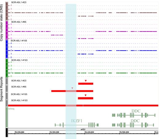 Figure 1. Representation from Genotyping Console 3.0 (Affymetrix) of IKZF1 deletions or monosomy 7 in 4 BCR-ABL1–positive ALL patients. Patients #23, #105, and #103 have a monoallelic deletion (DNA copy number state = 1) of different regions of IKZF1. Patient #95 shows a biallelic deletion. Normal diploid DNA content is shown as a continuous line of copy number state = 2. Red segment reports indicate the genomic extent of the IKZF1 deletions. The opalescent vertical box indicates the gap (chr7:50338126-50378125) inside the IKZF1 gene.