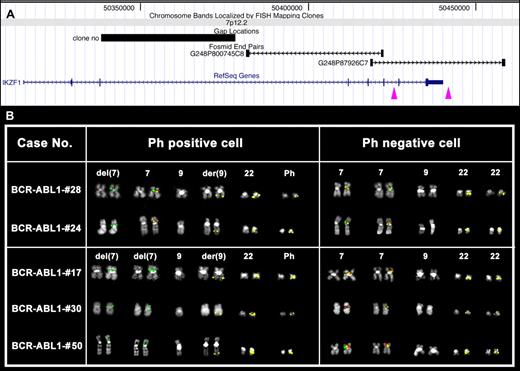 Figure 2. FISH analysis of IKZF1 deletions. (A) Map of the deletion proximal breakpoints within the IKZF1 gene is shown. Purple arrowheads indicate the breakpoint regions mapped by FISH experiments. Particularly, the left arrow corresponds to both Δ4-7 and Δ2-7 deletion proximal breakpoint regions, whereas the right arrow indicates a novel proximal breakpoint region identified in patient #17 (see panel B). (B) FISH results obtained in some of the cases under study showing homozygous (cases #17, #30, and #50) or heterozygous (cases #24 and #28) deletion of the fosmid clone G248P800745C8 (red) only in Ph+ (middle column), as shown by the FISH pattern of the RP11-164N13 (BCR) probe (in yellow). Clone G248P87926C7 (green) is always retained on deleted chromosomes 7. Notably, in patient #17, 1 of the 2 green signals is fainter than the other, revealing the occurrence of a partial deletion of G248P87926C7 in 1 of the 2 chromosome 7 homologs.