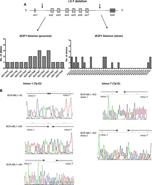 Figure 4. IKZF1 Δ2-7 breakpoints. (A) Schematic representation of Δ2-7 deletion with arrows indicating the region in which the breakpoints occur. In the graphs are shown the chromosome positions of breakpoints in the proximal (intron 1) and distal (intron 7) regions. The most frequent breakpoints occur at 50317927 and 50317933 in the proximal region and at 50431128 in the distal region. Primers used were C3/C4 and C5 (supplemental Table 2); products were then directly sequenced to characterize the sequence flanking deletion breakpoints. (B) Pherograms of sequencing of IKZF1 Δ2-7 breakpoints. Regions matching the reference genomic IKZF1 sequence are shown by arrows, separated by additional nucleotides not matching the consensus sequence.