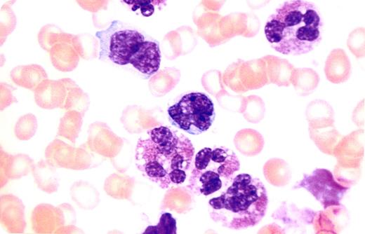 A 52-year-old woman presented to the hematologist with marked leukocytosis. She had a history of rash, weight loss, fevers, and lethargy for several months. There had been no foreign travel, use of drugs, gastrointestinal problems, joint disease, or pulmonary complaints. Physical findings included a macular and erythematous rash, pallor, clear lungs, mild hepatomegaly, moderate enlargement of the spleen, and slight adenopathy. Laboratory findings included a white cell count of 144 × 109/L of which 60% were eosinophils. Other results included a hemoglobin of 102 g/L, platelets of 106 × 109/L, normal renal function, and mild liver function abnormalities. A peripheral blood smear showed the prominence of eosinophilia. However, a population of atypical lymphoid cells was also present, many of which had lobulated nuclear form. The bone marrow was markedly hypercellular with abundant eosinophils in all stages of maturation. Occasional collections of lymphoid forms were noted similar to those seen on the peripheral smear. Lymph node and liver biopsies were performed and a diagnosis of mycosis fungoides was made. The peripheral blood lymphoid cells were considered as Sézary cells. / Eosinophils are cytokine-mediated cells that are reactive to an underlying disorder or part of a primary hematologic disease. Eosinophilia is frequently noted in allergies, skin diseases, parasites, pulmonary disorders, immune diseases, and malignancies, especially lymphoid diseases. Persistent marked elevations of eosinophils characterize hypereosinophilia. In this patient, the presence of hypereosinophilia raised the possibility of a primary eosinophilic disorder with the effects of eosinophil-derived toxic mediators that can be seen in myeloproliferative diseases, chronic eosinophilic leukemia, and mast cell disease. However, the peripheral smear showed atypical lymphoid cells that provided the clue that eosinophilia was secondary to non-Hodgkin lymphoma. The rash, coupled with Sézary cells, helped to establish the diagnosis of mycosis fungoides.