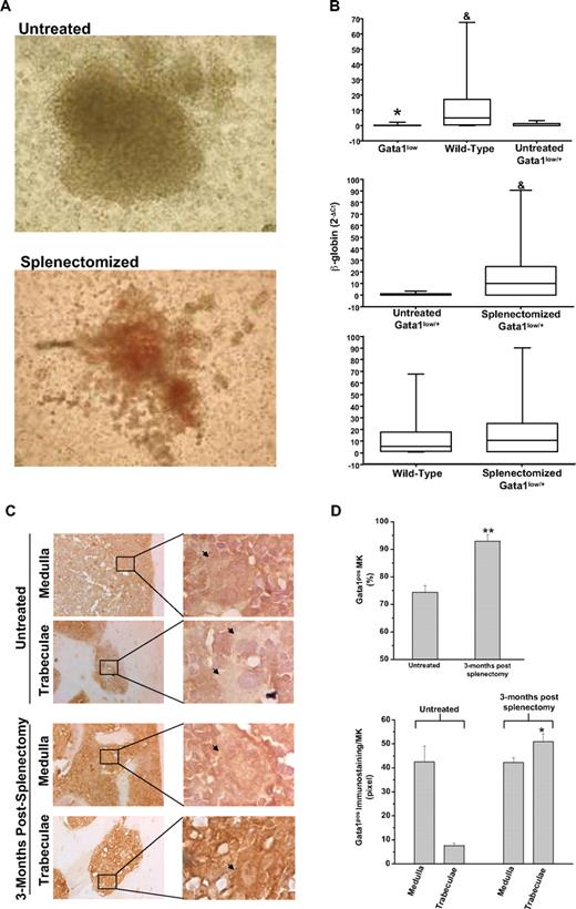 Figure 1. The erythroid progenitors and the MKs present in the marrow of splenectomized Gata1low/+ mice are predominantly derived from the stem cell population expressing the wild-type Gata1 allele. (A) Photograph of a representative erythroid colony generated from the marrow of untreated and splenectomized 18-month-old Gatalow/+ female littermates. Magnification: ×10. (B) Statistical analyses of the levels of β-globin expressed by single erythroid colonies generated in marrow cultures of untreated wild-type, Gata1low/0, and Gata1low/+ mice (top panel) or from untreated and splenectomized Gata1low/+ littermates (middle panel) or from wild-type and splenectomized Gata1low/+ mice (bottom panel). Results are expressed as median (the line across the boxes), 25% to 75% interquartile range (the boxes), and maximal and minimal value (the end of the vertical line across the boxes). Differences in expression levels were compared by Kruskal-Wallis and Bonferroni-Dunn posthoc tests (top panel) or by Mann Whitney test (middle and bottom panels). * and & indicate levels of β-globin significantly lower (P < .001) than those expressed by cells from wild-type and untreated Gata1low/+ females, respectively (see supplemental Table 1 for further details). (C) Gata1 immunostaining of bone sections of untreated Gata1low/+ mice (top panels) and mice 3 months after splenectomy (bottom panels). All the mice were 9 to 10 months old. Because, to avoid interference with the immunostaining (in brown), the slides were not counterstained with hematoxylin-eosin, MKs are indicated by arrows for clarity. Magnification: ×20. Representative areas (indicated by rectangles) corresponding to the medulla and the bone trabeculae are also represented at ×100 magnification. Similar results were observed with 3 additional untreated and splenectomized Gata1low/+ mice. (D) Frequency of Gata1pos MKs (top panel) and level of Gata1 staining in single Gata1pos MKs (bottom panel) from untreated and splenectomized Gata1low/+ females. Results are presented as mean (± SD) determinations with 3 mice per experimental group. The frequency of Gata1pos cells was determined by analyzing at ×40 magnification 100 MKs for each mouse. The level of Gata1 immunostaining in Gata1pos MKs was determined on 5 MKs randomly chosen in the medullar or in the trabecular area of the bone for each animal with the MetaMorph 6.1 program. Values statistically different (P < .05 or P < .001) from those observed in untreated mice are indicated by * and **, respectively.