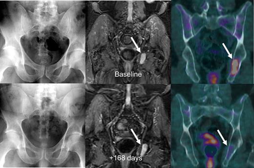Figure 3. Untreated myeloma patient with time-concordant MBS, MRI, and FDG-PET/CT studies. Baseline imaging studies (top row) showed no osteolysis on MBS (top left), several foci on STIR-weighted MRI images with the largest in the left ischium (top middle), and 2 foci on FDG-PET/CT imaging (top right) with the largest again in the left ischium with a maximum SUV of 4.1. The patient was in near-complete remission 168 days later, with a significant decrease in focal activity in the left ischial lesion on PET (bottom right).