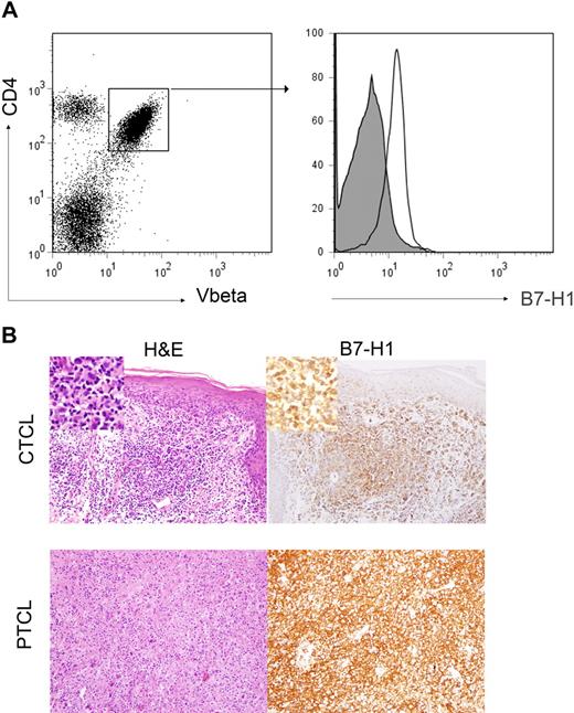 Figure 1. B7-H1 is expressed by malignant T cells. (A) PBMCs from patients with Sezary syndrome were analyzed by flow cytometry. Malignant T cells were identified by the expression of both CD4 and the clonotypic TCR Vβ chain, as shown in the representative dot plot. Samples were stained with an isotype control (closed histogram) or anti–B7-H1 (open histogram) and B7-H1 expression on malignant CD4+Vβ+ cells determined. For cases in which TCR Vβ use was unknown, malignant CD4+ T cells were identified by the aberrant down-regulation of CD7. A representative example (n = 11) is shown. (B) Immunohistochemical staining for B7-H1 was performed in paraffin-embedded biopsy specimens obtained from CTCL (n = 11) and PTCL (n = 144) patients and tumor-associated B7-H1 expression analyzed. Tumor cells were scored as B7-H1+ when B7-H1 and T cell–specific antibodies (eg, CD3, CD4, and CD8) both stained an identical population of cells, as determined by an expert hematopathologist. Two representative examples are shown (original magnification ×200).