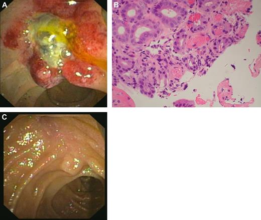 Figure 2. A case of catastrophic APS with involvement of the ampulla of Vater. (A) Morphologic appearance (on endoscopic examination) of ampulla of Vater, which is grossly edematous and unusual in appearance. (B) Ampullary biopsy showing small-vessel thrombosis. (Olympus BX41 microscope, objective lense used was the Olympus UPLANF 40×/0.75NA dry, original magnification ×400, H&E stain; camera: NIKON COOLPIX 995, image acquistion software: Olympus CAMEDIA Master.) (C) Resolution of changes after treatment with intravenous anticoagulation, corticosteroids, antibiotics, plasma exchange, and intravenous immunoglobulin.