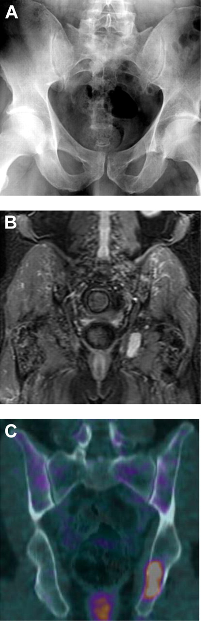 PET/CT is superior over conventional radiography. In the figure created by Bartel and colleagues, the conventional radiography of the pelvis (A) showed no osteolysis, while there were several foci on STIR-weighted MRI images with the largest in the left ischium (B), and 2 foci on FDG-PET/CT imaging (C) with the largest again in the left ischium with a max SUV of 4.1. See the complete figure in the article beginning on page 2068.