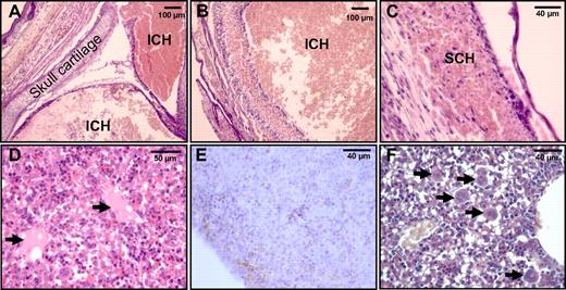 Figure 6. Thrombotic phenotype in homozygous E17.5 Pros−/− embryos. Histologic analysis of E17.5 Pros−/− embryos demonstrated extensive intracranial hemorrhages (ICH; A-B) and subcutaneous hemorrhages (SCH; C), together with the presence of thrombi (arrows) in the liver (D). Fibrin deposition in E17.5 Pros−/− livers was evidenced by immunostaining with a polyclonal antibody raised against mouse fibrinogen (E). Histologic analysis also demonstrated an increased number of megakaryocytes in E17.5 Pros−/− livers (F), secondary to peripheral thrombocytopenia. Together with interstitial fibrin deposition, this suggested consumptive coagulopathy in E17.5 Pros−/− embryos.