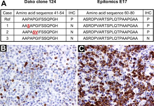 Figure 1. Correlation between the presence of mutations in the BCL2 gene and BCL2 protein expression by immunohistochemistry using clones 124 and E17. (A) BCL2 protein expression by immunohistochemistry and corresponding amino acid sequence derived from sequencing the BCL2 gene in 3 BCL2+/MYC+ lymphoma samples. The affected amino acid changes are highlighted in red. (B) DLBCL sample (sample 2) stained with the BCL2 antibody clone 124 (Dako North America; original magnification ×200). (C) The same DLBCL sample (sample 2) stained with the BCL2 antibody E17 (Epitomics; original magnification, ×200). Ref indicates reference genome hg 19, May 2009; IHC, immunohistochemistry; P, positive; and N, negative.