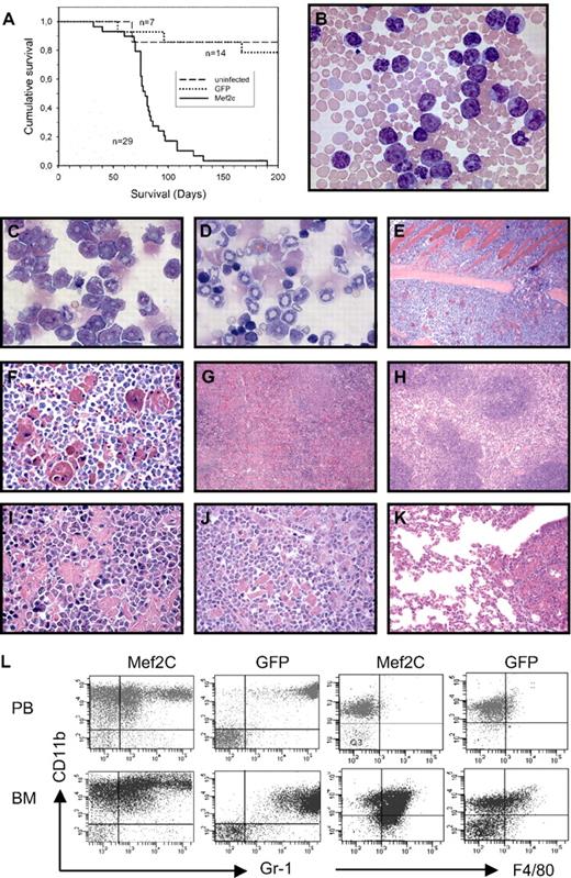 Figure 2. Ectopic expression of Mef2c into Irf8−/− BM progenitors induces acute myelomonocytic leukemia in recipient mice. (A) Kaplan-Meier survival curves of mice receiving Irf8−/− BM cells after infection with retroviral vectors carrying Mef2c/GFP or GFP alone, or uninfected controls, are shown. (B) Blood smear of moribund mouse receiving Mef2c-Irf−/− BM cells shows leukocytosis composed predominately of immature blastlike monocytic and granulocytic cells. The heterochromatic erythrocytes reflect a moderate anemia, confirmed by hematocrit values between 27 and 42 (normal values, 42-48; Pappenheim stain; 63×/1.4 oil). (C-D) Cytospin of BM cells from mice transplanted with either Mef2c/GFP (C) or GFP (D) Irf8−/− BM. The accumulation of blastlike cells and immature monocytes is observed in BM with ectopic Mef2c expression, in contrast to controls, which show the typical increase in granulopoiesis and immature erythropoiesis characteristic of Irf8−/− mice. In addition to juvenile forms, mature banded granulocytes are the prominent form (Pappenheim stain; 63×/1.4 oil). (E-F) Sternal BM of mouse transplanted with Mef2c-Irf8−/− BM showing considerable hypercellularity associated with left-shifted monocytosis and granulocytosis and reduced numbers of erythroid cells. The sinusoidal vascular system is compressed and obscured and an eruption of leukemic cells through the nutrient foramina, which normally allows vascularization of the BM cavity, is observed, leading to the invasion of leukemic BM cells into the neighboring thoracic musculature (top half of microphotograph; 10×/0.45). Higher magnification clearly shows myeloid blast and immature forms of the invasive cells and the numerous phagocytic cells with an eosinophilic storage phenomenon in their cytoplasm (hematoxylin and eosin stain; 40×/1.3 oil). (G-I) Splenic sections of mice receiving either Mef2c (G,I) or control GFP (H) Irf8−/− BM. The regular splenic architecture observed in control mice (H) is completely effaced in Mef2c mice because of the myeloid hyperplasia of the red pulp. As in the BM, an abundance of pseudo pseudo-Gaucher cells with intracellular accumulation of para-crystalline substance at different stages of development can be observed. Large storage cells showing hemophagocytosis are also present (I). Pockets of erythroid cells are observed, which compensates for the loss of erythropoiesis in the BM (hematoxylin and eosin stain; 10×/0.45 and 63×/1.4 oil). (J-K) The highly invasive behavior of the leukemic cells is evidenced by infiltration into nonhematopoietic tissue. (J) Similar to the spleen, the normal liver lobular architecture is completely destroyed and periportal and perivenous liver parenchyma is replaced by infiltrating leukemic myeloblasts and immature forms, as well as phagocytic histiocytes (hematoxylin and eosin stain; 40×/1.3 oil). (K). Pulmonary infiltration with hematopoietic cells was observed in all animals analyzed. Focal peribronchial and perivascular accumulation of immature myeloid and phagocytic histocytes is seen, as well as the diffuse thickening of the avelolar septa by leukemic infiltration (hematoxylin and eosin stain; 20×/0.75). (L) Flow-cytometric analysis of cells isolated from BM and PB from Mef2C and control GFP-transduced mice. Expression analysis of CD11b, Gr1, and F4/80 confirmed the prominent monocytic component of the AML induced by Mef2c. Only GFP+ cells are shown. The results are representative of all mice analyzed.