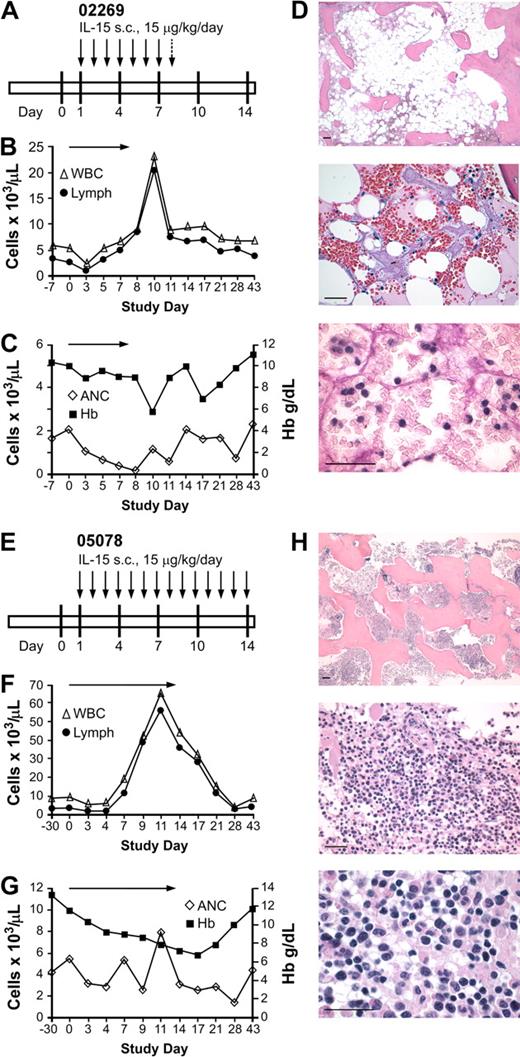Figure 1. Effect of daily subcutaneous IL-15 in 2 immunocompetent macaques. (A) Schedule of IL-15 administration (15 μg/kg per day). Each represents a single daily dose of IL-15 (15 μg/kg), and the indicates a single daily dose of IL-15 (5 μg/kg). (B-C) Absolute numbers of WBCs, lymphocytes, and neutrophils (ANCs) in the peripheral blood before, during, and after IL-15 therapy. Absolute cell numbers of (B) WBCs (▵) and lymphocytes (●) per microliter of peripheral blood or (C) ANCs (◇) per microliter of peripheral blood and level of hemoglobin (■ Hb; gd/L) were determined on the indicated days. The arrows indicate the duration of the IL-15 administration. (D) Photomicrographs of hematoxylin and eosin–stained BM biopsy sections obtained after 7 days of treatment display hypoplasia and moderate focal hemorrhage (top, 5× objective). At higher magnification (middle, 40× objective), there is also fat necrosis and stromal edema. The scattered cells are erythroid precursors, lymphocytes, and macrophages. Normal clusters of maturing myeloid cells are absent (bottom, 100× objective). Photomicrographs were obtained with a Leica DFC320 camera on a Leica DM3000 microscope and processed with the Leica Application Suite version 3.1.0 (Leica Microsystems GmbH). Images were processed using Photoshop 7.0 software (Adobe Systems). Bars represent 100 micrometers. (E) Schedule of IL-15 administration for macaque 05078 (15 μg/kg per day). Each represents a single daily dose of IL-15. (F) Absolute cell numbers of WBCs (▵) and lymphocytes (●) per microliter of peripheral blood before, during, and after IL-15 therapy. (G) ANCs (◇) per microliter of peripheral blood and level of hemoglobin (■ Hb; gd/L) before, during, and after IL-15 therapy. indicates the duration of the IL-15 administration. (H) Photomicrographs of hematoxylin and eosin–stained marrow biopsy sections obtained after the IL-15 treatment as described in panel D. Bars represent 100 micrometers.
