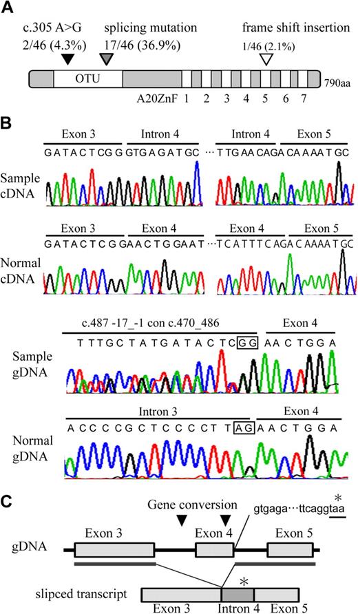 Figure 3. Distribution and features of A20 mutation in ABC DLBCL and MCL. (A) Schematic representation of human A20 with its functional domains. OTU is a deubiquitinating enzyme domain. A20 ZnF indicates the A20 zinc finger domain, which exerts E3 ligase activity. The location of A20 mutations is represented on the map with triangles. (B) Electrofluorograms showing partial nucleotide sequence of the A20 cDNA and genomic DNA (gDNA) of the patient sample and normal control. The splicing mutation in the patient results in exon 4 skipping and inclusion of whole intron 4 sequence. The intrallelic gene conversion in the patient disrupts a consensus sequence of acceptor splicing site of intron 3 (c.582_634 con c.434_486). Square in the sequence represents consensus sequence of splicing acceptor site. (C) Schematic representation of exon 4 skipping is shown. The location of gene conversions is represented on the map in triangles. The gene conversion may induce activation of cryptic splicing acceptor site of exon 4. Inclusion of whole intron 4 sequence in aberrantly spliced product adds 90 nucleotides followed by a stop codon (*).