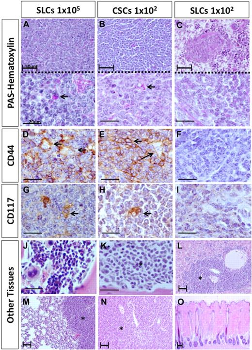 Figure 5. Histologic and immunohistochemical analyses of spleen after transplantation. At 60 days, lymphoma was regenerated after the transplantation of 105 SLCs and 102 CSCs. No lymphoma was observed after the transplantation of 102 non-CSCs. (A) PAS-hematoxylin staining in the 105 SLCs recipient spleen. (Top panel) Low magnification. (Bottom panel) High magnification. Strong PAS+-stained cells were observed (). (B) PAS-hematoxylin staining in the 1 × 102 CSCs recipient spleen. (C) PAS-hematoxylin staining in the 1 × 102 non-CSCs recipient spleen. No strong PAS+ staining cells were evident. (D-I) Immunohistochemistry of CD44 and CD117, shown in the 105 SLC recipient spleen (D,G), in the 102 CSC recipient spleen (E,H), and in the 1 × 102 SLC recipient spleen (F,I). CD44 and CD117 expression is detected in the lymphoma in the spleen after 1 × 105 SLC and 1 × 102 CSC transplantation. (J) Hematoxylin and eosin (H&E) staining of the normal NOD/SCID mouse BM. Various types of blood cells, including megakaryocytes and erythroid cells, were evident. (K) Hematoxylin and eosin staining of lymphoma reconstituted in the NOD/SCID mouse BM. The BM tissue was uniformly filled with ATL-like lymphomatous cells. (L) Infiltration of lymphomatous cells was also observed in the liver. (M) Infiltration of lymphomatous cells in lung. (N) Infiltration of lymphomatous cells in lymph nodes. (O) Infiltration of lymphomatous cells was not observed in the epidermal tissues. *Lymphomatous cells. (Closed scale bar, 50 μm; open scale bar, 20 μm.)