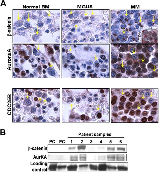 Figure 6. β-catenin affects expression of target genes in patient sample tissue microarrays. (A) IHC analysis on patient sample tissue microarrays show that AurKA and CDC25B reflect increased β-catenin expression from MGUS to MM compared with normal BM. Costaining of β-catenin (red) and AurKA (brown) in top right panel inset. (B) Immunoblot analysis of AurKA expression normal plasma cells (PC) and MM primary tumors compared with β-catenin expression. Note a correlation between β-catenin and AurKA expression in patient samples 1, 2, 5, and 6.