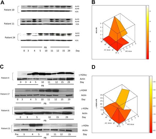 Figure 6. Changes in H3/H4 acetylation and the DNA damage marker γ-H2AX in peripheral blood (PB) during therapy with 5AC and entinostat. (A) Western blotting of H3/H4 acetylation results from 3 representative patient samples (patients 10, 11, and 24) during the first cycle of treatment. H2A was used as a loading control. AcH3 and AcH4 indicate acetylated H3 and acetylated H4, respectively. Note that day-3 samples were procured before any administration of the HDAC inhibitor. (B) Three-dimensional representation of interaction between doses of 5AC and entinostat (denoted MS) administered and median maximal H4 acetylation in peripheral blood mononuclear cells. The median values of the intensity index of acetylated H4 after normalization with nonacetylated H2A (loading control) are shown. The maximal increase in H4 acetylation was observed with the sequential administration of 5AC (40 and 50 mg/m2) and entinostat (6 and 8 mg). (C) DNA damage induction in both clinical responders and nonresponders during the first cycle of treatment. Western blotting showing up-regulation of γ-H2AX in 2 clinical responders (patients 4 and 17) and 2 clinical nonresponders (patients 6 and 21). Actin was used as a loading control. Day-15 (empty lane) and day-29 samples were not available for patients 17 and 21, respectively. Day-4, -11, and -12 samples were not available for patient 6. (D) Three-dimensional representation of relationship between doses of 5AC and entinostat (denoted MS) administered and median maximal γ-H2AX induction in peripheral blood mononuclear cells. The median values of the intensity index of γ-H2AX after normalization with actin (loading control) are shown.