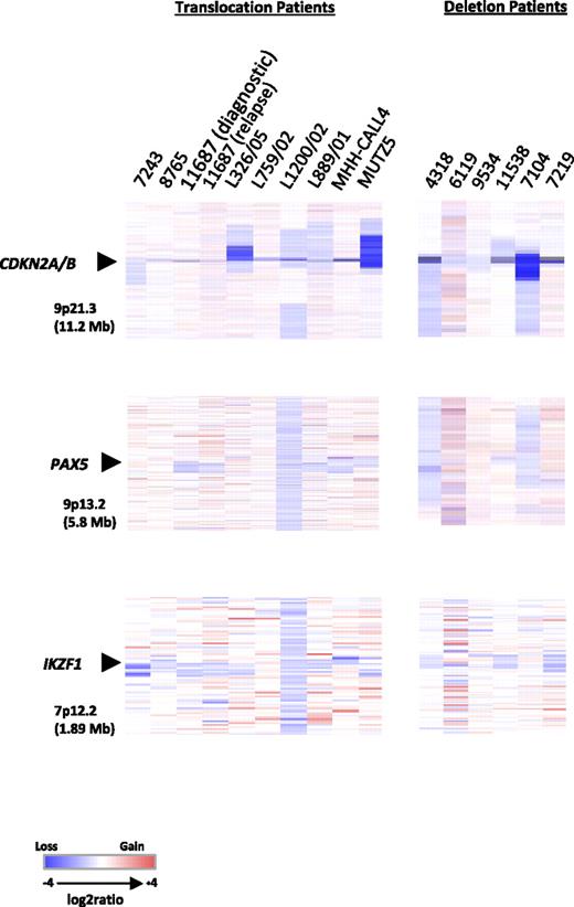 Figure 4. Heat maps of 13 diagnostic BCP-ALL samples, 1 relapse, and 2 cell lines. Focal deletions of CDKN2A/B, PAX5, and IKZF1. Data are divided by aberration: translocation, t(X;14)(p22;q32) and t(Y;14)(p11;q32), and deletion, del(X)(p22.33p22.33) and del(Y)(p11.32p11.32). For samples with the translocations (7 diagnostic, 1 relapse, and 2 cell lines), data were generated using the Human Genome CGH Microarray 244A platform and for samples with the deletion (6 diagnostic) the Human Genome CGH Microarray 105K platform was used. In all heat maps, each sample is represented by a single column, as indicated by the sample identifier at the head of the figure, and each row denotes the log2 ratio for each probe. The probes are plotted in genomic order (hg18) with losses and gains in blue and red, respectively. The size of the regions shown is given in parentheses. Note that the additional probes on the Human Genome CGH Microarray 105K platform for the PAR1 region failed.