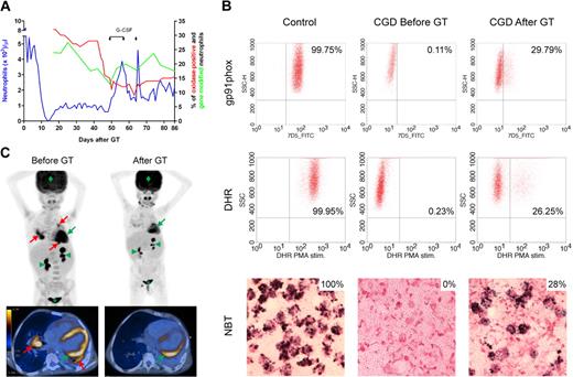 Figure 1. Restoration of NADPH oxidase function. (A) Hematopoietic reconstitution and gene marking after GT. Absolute neutrophil counts (left y-axis), quantification of gene-modified cells in peripheral neutrophils by quantitative polymerase chain reaction and quantification of neutrophils with NADPH oxidase activity by DHR test (right y-axis) are shown. When the percentage of transduced neutrophils decreased, granulocyte colony-stimulating factor (5 μg/kg per day subcutaneously) was administered on days 49 to 57 and on day 64. (B) Reconstitution of NADPH oxidase activity. Before and 6 weeks after GT, gp91phox protein expression was measured by FACS analysis after 30 minutes of staining with 10 μg/mL gp91phox-FITC antibody. Superoxide production was assessed by oxidation of DHR on stimulation with PMA and by reduction of nitroblue tetrazolium to formazan (dark precipitate) after stimulation with opsonized zymosan. The thresholds were determined using unstained (FACS) or unstimulated (DHR) cells for each experiment. (C) PET-CT scan. Before GT, PET-CT scan showed several active infectious foci with fluorine-18-fluoro-2-deoxy-D-glucose uptake in both lungs of the patient (red arrows); the infection cleared 6 weeks after administration of gene-corrected cells. In green, physiologic FDG uptake in heart (arrow), kidneys (arrowheads), bladder (*), and brain (diamond) are indicated for reference.