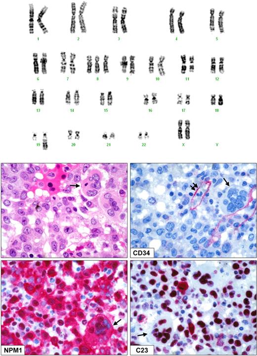 Figure 2. Morphology and immunophenotype of NPMc+ AML with AK. The figure shows the morphologic and immunohistologic features of a representative example of NPM1-mutated AML with AK 47,XX,+8,der(19)t(13;19)(q12;q13) (top panel). These features are identical to those observed in the typical NPM1-mutated AML cases with NK. (Middle left) Diffuse marrow infiltration by leukemic cells with myelomonocytic appearance. The arrow points to a dysplastic megakaryocyte (paraffin section from bone marrow biopsy; hematoxylin-eosin; ×1000). (Middle right) Leukemic cells are CD34−. The single arrow indicates a dysplastic megakaryocyte, while the double arrows indicate a CD34+ vessel. (Bottom left) Myelomonocytic leukemic cells and a dysplastic megakaryocyte (arrow) show aberrant cytoplasmic expression of nucleophosmin (NPM1), indicating they belong to the same clone; cells showing nucleus-restricted expression of nucleophosmin represent normal residual hemopoietic precursors. (Bottom right) Leukemic cells and a dysplastic megakaryocyte (arrow) show nucleus-restricted positivity for C23/nucleolin. (Middle right and bottom panels) Immunostaining of paraffin sections from bone marrow biopsy using the alkaline phosphatase monoclonal anti-alkaline phosphatase (APAAP) technique; hematoxylin counterstaining; ×1000. All images were collected using an Olympus B61 microscope and a UPlan FL 100×/1.3 NA oil objective; Camedia 4040, Dp_soft Version 3.2; and Adobe Photoshop 7.0.