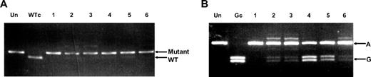 Figure 2. JAK2 exon 19 SNP genotype analysis of V617F mutant alleles. (A) Gel showing AflIII restriction enzyme digest of 14(MM)F + 15R PCR products amplified from 14(MM)F + 20R second-round PCR products that were obtained from 6 ET patients. V617F mutant–positive products remained undigested. Un indicates no restriction enzyme added; WTc, wild-type control. (B) Gel showing BstNI restriction enzyme digest of 18F + 20R PCR products amplified from the same 14(MM)F + 20R second-round PCR products. Exon 19 SNP allele G, but not A, products were digested. Un indicates no restriction enzyme added; Gc, allele G control.