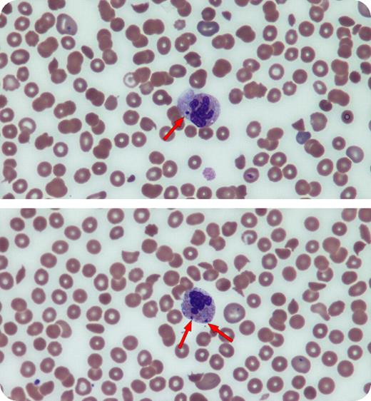 A 40-year-old HIV-positive man was evaluated for fatigue, weakness, fever, and cough. He was not taking any medications. His blood count showed normocytic anemia, leukopenia, and thrombocytopenia (hemoglobin 85.0 g/L, mean corpuscular volume 99 fL, white blood cell count 1.9 × 109/L, platelets 50 × 109/L). His CD4 count was 0.05 ×109/L. Other laboratory tests showed normal B12, folate, thyroid, and liver function tests. Review of his peripheral blood smear revealed the presence of polychromasia, occasional schistocytes, acanthocytes, target cells, and elliptocytes. Several neutrophils showed dysgranulopoietic features that included discrete, basophilic cytoplasmic inclusions (Howell-Jolly body–like inclusions) and occasional hypersegmented cells. The patient refused having bone marrow aspiration and biopsy. Pancytopenia with dysplastic features is common in patients with HIV infection. However, other conditions that cause myelodysplasia, such as nutritional disturbances, myelodysplastic syndrome, and sequelae of chemotherapy or transplantation, must be considered. With HIV infections, the presence of detached nuclear fragments in the cytoplasm of neutrophils that bear a resemblance to the nuclear remnants of red cells known as Howell-Jolly bodies can be found. These unusual inclusions should be differentiated from other intracytoplasmic inclusions, such as those that may be seen in infections or in rare inherited disorders, for example, Chediak-Higashi syndrome.