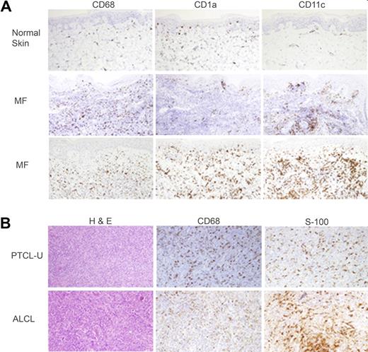Figure 1. T-cell lymphoproliferative disorders are associated with a rich infiltrate of monocyte-derived cells. Normal skin and biopsies obtained from CTCL patients with mycosis fungoides (A) or lymph node biopsies from patients with PTCL (B) were stained for monocyte-derived macrophages (CD68) or dendritic cells (CD1a, CD11c, S-100). Representative examples (CTCL, n = 10; PTCL, n = 12) are shown (×200).