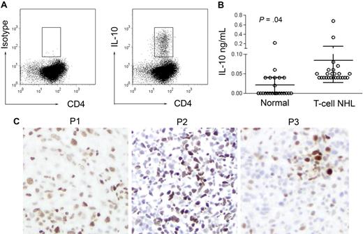 Figure 6. Malignant T cells produce IL-10 and STAT-3 is phosphorylated within the tumor microenvironment. (A) PBMCs obtained from CTCL patients were cultured in the presence of PMA, ionomycin, and brefeldin A. Malignant T cells were identified as before and intracellular staining for IL-10 was performed. A representative example is shown (n = 2). (B) Plasma was obtained from normal donors (n = 24) and T-cell NHL patients (n = 25) and IL-10 levels were determined (mean ± 95% confidence interval is shown; P = .04). (C) Immunohistochemical analysis of pSTAT3 expression in CTCL biopsy specimens was performed (n = 10). Three representative examples are shown (×200).