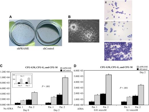 Figure 5. PRAME silencing in primary CML progenitor cells increases myeloid colony formation. (A) shPRAME-transduced cells (left) compared with shControl cells (shGFP, right) from 3 CML blast crisis patients exhibited increased colony formation on agarose both in the absence and presence of ATRA at 0.01 and 0.1 μM. Colonies arising from shPRAME and shControl cells exposed to 0.01 μM ATRA from 1 patient are shown. (B) To confirm colony morphology after exposure to GM-CSF and G-CSF individual colonies (i) were plucked and stained with Wright-Giemsa. Colony types were predominately granulocytic (CFU-G, ii) or monocytic (CFU-M, iii), but CFU-GMs (iv) were also seen. (C) shPRAME silenced CML cells compared with shControl cells from 3 patients demonstrated increased numbers of CFU-GMs, CFU-Gs, and CFU-Ms on days 0 and 2. The mean colony numbers from independent experiments performed in triplicate are shown. The numbers represented on the y-axis indicate the numbers of progenitor cells in culture on each experimental day that gave rise to a colony. (D) For 2 patients, sufficient cells were available to assess CFU formation after exposure to ATRA at 0.01 μM and 0.1 μM. Similar to the phenotype seen in the absence of ATRA, shPRAME cells compared with shControl cells formed increased numbers of CFU-GM, CFU-G, and CFU-M colonies. Day 2 is shown; day 4 shows the same increase in CFUs in shPRAME cells compared with shControl cells (included in calculations of statistical significance). Furthermore, the same differences were observed in 1 patient whose cells were treated with 0.001 μM ATRA. The mean numbers of colonies are shown from independent experiments performed in triplicate. The numbers represented on the y-axis indicate the numbers of cells in culture on a particular experimental day that gave rise to a colony.