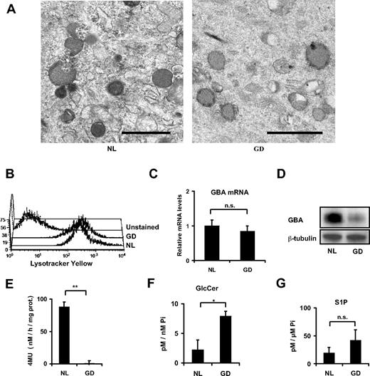 Figure 2. Lysosomal and GBA studies. (A) Transmission electron microscope photography of passage 5 MSCs, the lysosomes being the dark gray organelles; scale bar = 1 μm. (B) Total lysosomal content assessed by flow cytometry of Lyso Tracker Yellow–stained passage 3 MSCs. (C) Relative mRNA levels for GBA in passage 4 MSCs. (D) Scanned autoradiogram of a Western blot performed for GBA expression analysis on passage 4 MSCs, with β-tubulin expression used as a loading control on the same samples. The large band for GBA is explained by differently glycosylated forms of GBA. (E) GBA enzymatic activity expressed in nanomoles of 4-MU formed per hour per milligrams of total protein content in the sample. **P < .001. (F-G) Sphingolipids were analyzed in normal and Gaucher disease MSCs by high-performance liquid chromatography–tandem mass spectrometry and were normalized for total cellular inorganic phosphate. Shown are glucosylceramide levels (F) and sphingosine-1-phosphate (G). *P < .05. All error bars represent 1 SD.