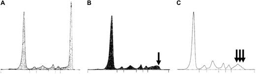 Figure 1. Complete response assessment by electrophoresis: examples of pitfalls. Patient with an initial spike in the gammaglobulins region (M-IgG) (A) was first considered in n-CR (positive immunofixation and normal electrophoresis). The tracing was reviewed by an independent expert committee who noticed the persistence of a small spike (B, ) and reclassified this case as VGPR. (C) Post-ASCT oligoclonal gammopathy ( ). Because one of the small spikes corresponded to the same isotype as the original M-component, this patient was considered in VGPR.